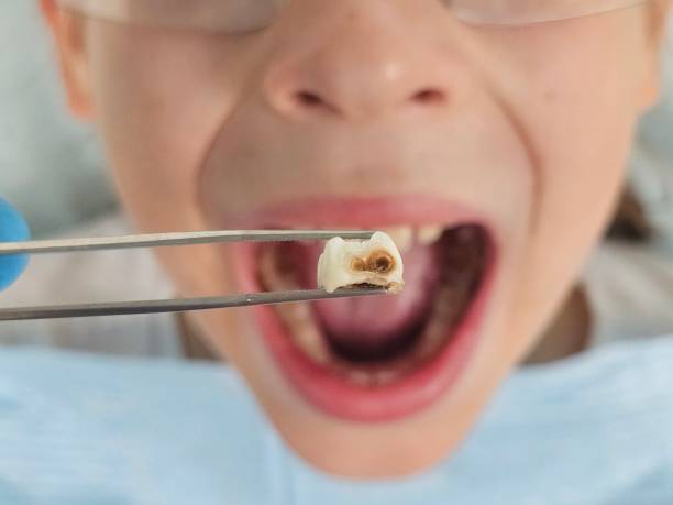 Best Emergency Dental Care for Broken or Chipped Teeth in Reeds Spring, MO